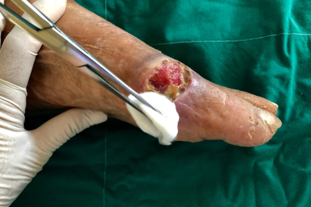 Orthopedic Treatment for Infected Diabetic Foot Wounds