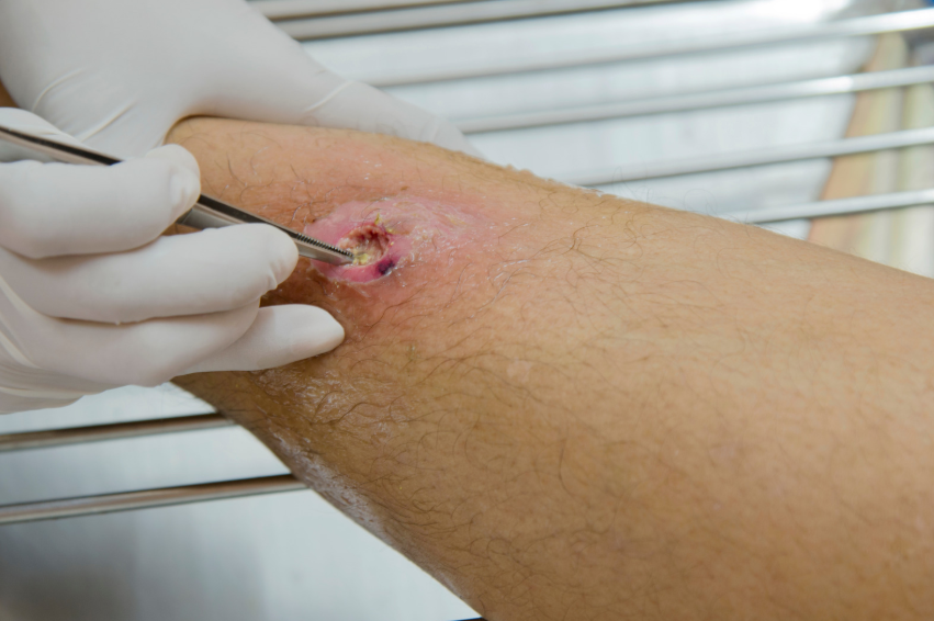 Orthopedic Treatment for Infected Wounds