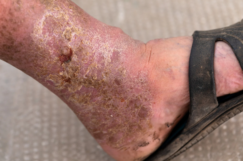 Orthopedic Treatment for Forefoot Ulcers