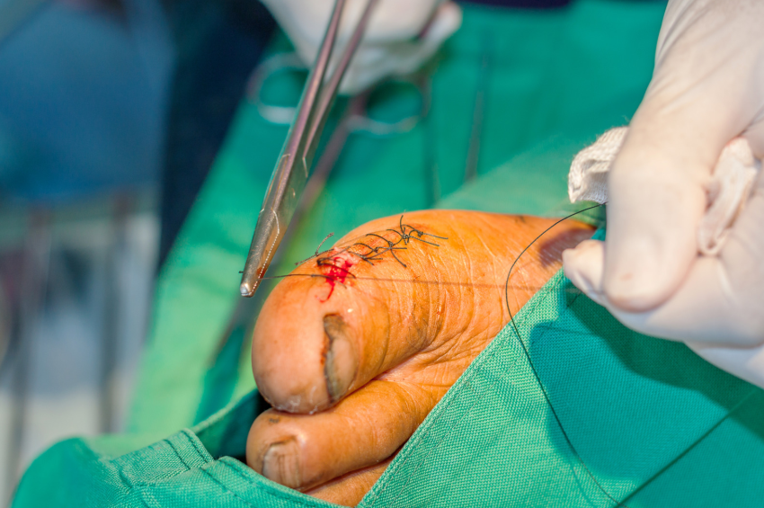 Surgical wound debridement Philippines