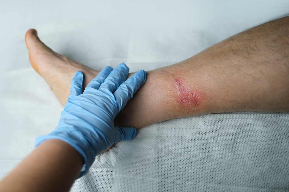 Doctor for Infected Wounds When to Seek Help and What to Expect