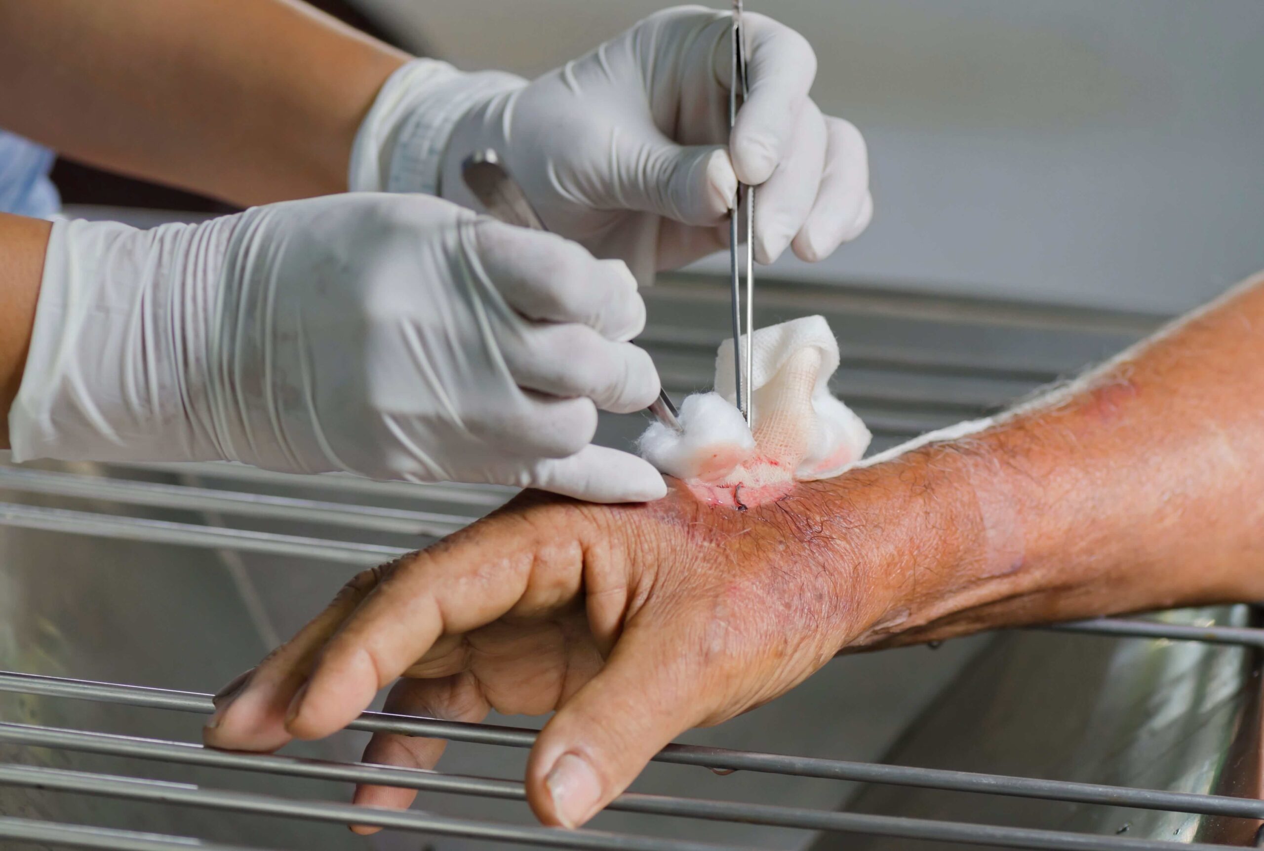 Understanding Wound Debridement Services What Patients and Caregivers Need to Know