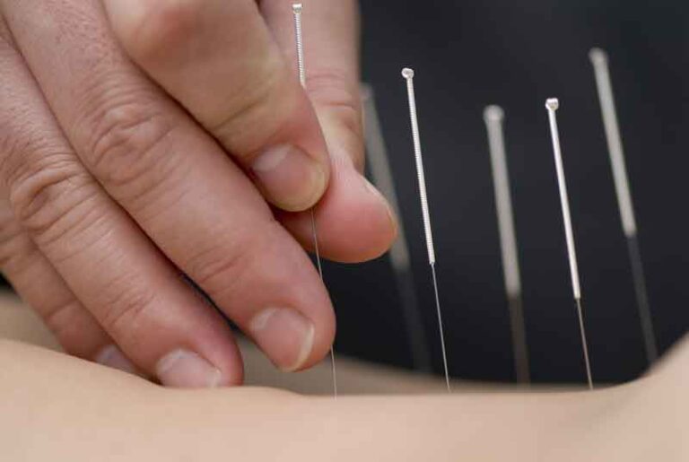Discover the Healing Power of Dry Needling Treatment in Fishers A Modern Approach to Pain Relief and Muscle Recovery