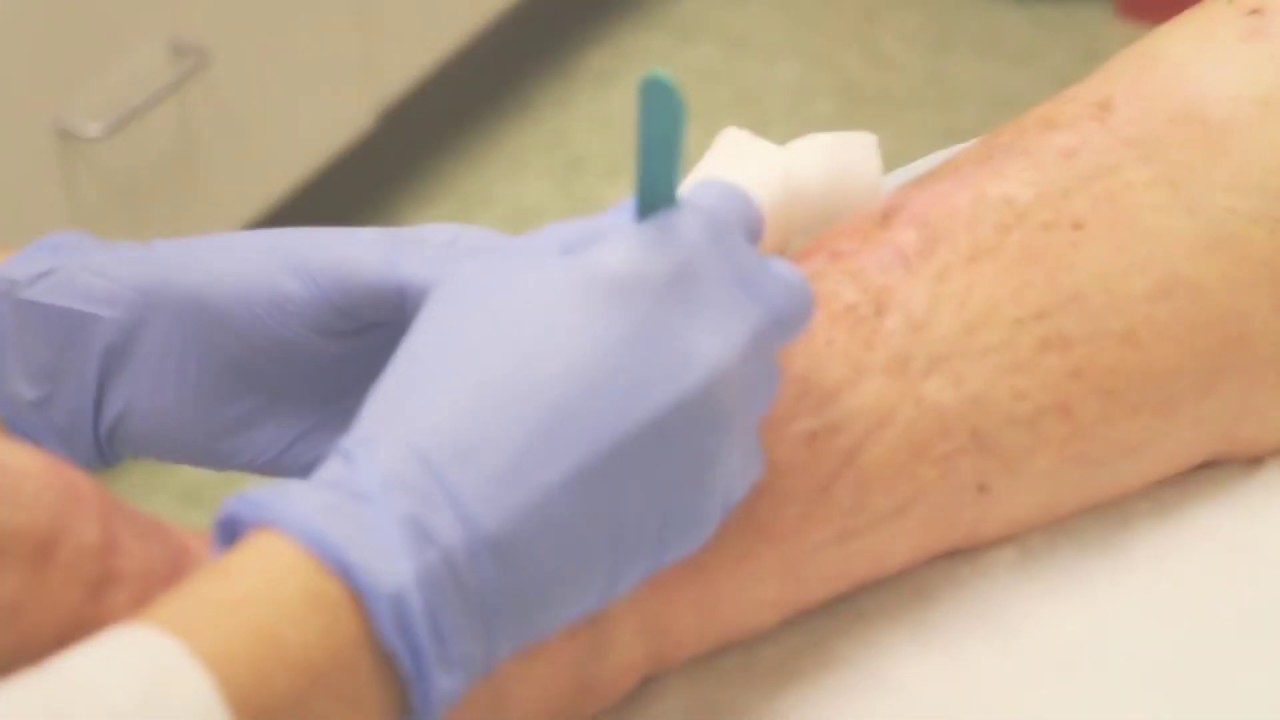 Dead Tissue Removal: Essential Guide to Healing and Recovery
