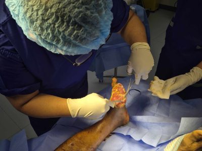 Wound Debridement Manila
